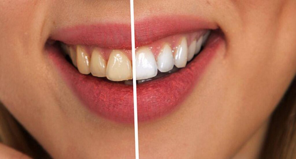 witten tanden tips zonder behandeling