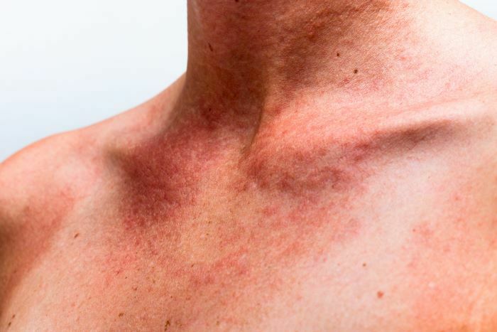 huid-irritatie-zon